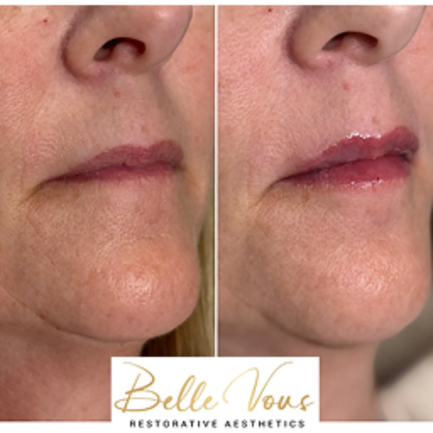 lip filler in Williamsville, NY