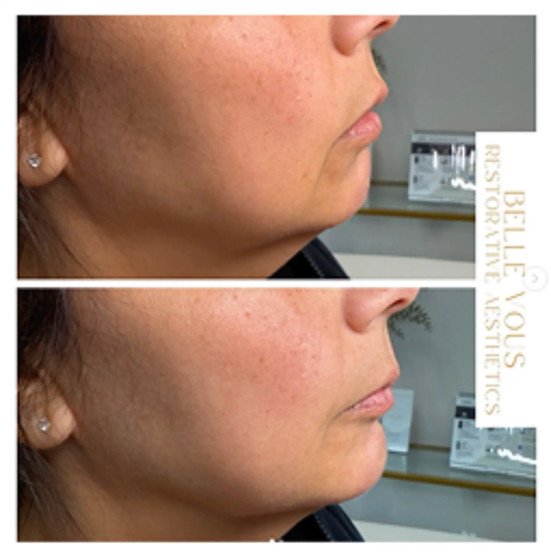 Chin filler two before and after gallery in Williamsville NY