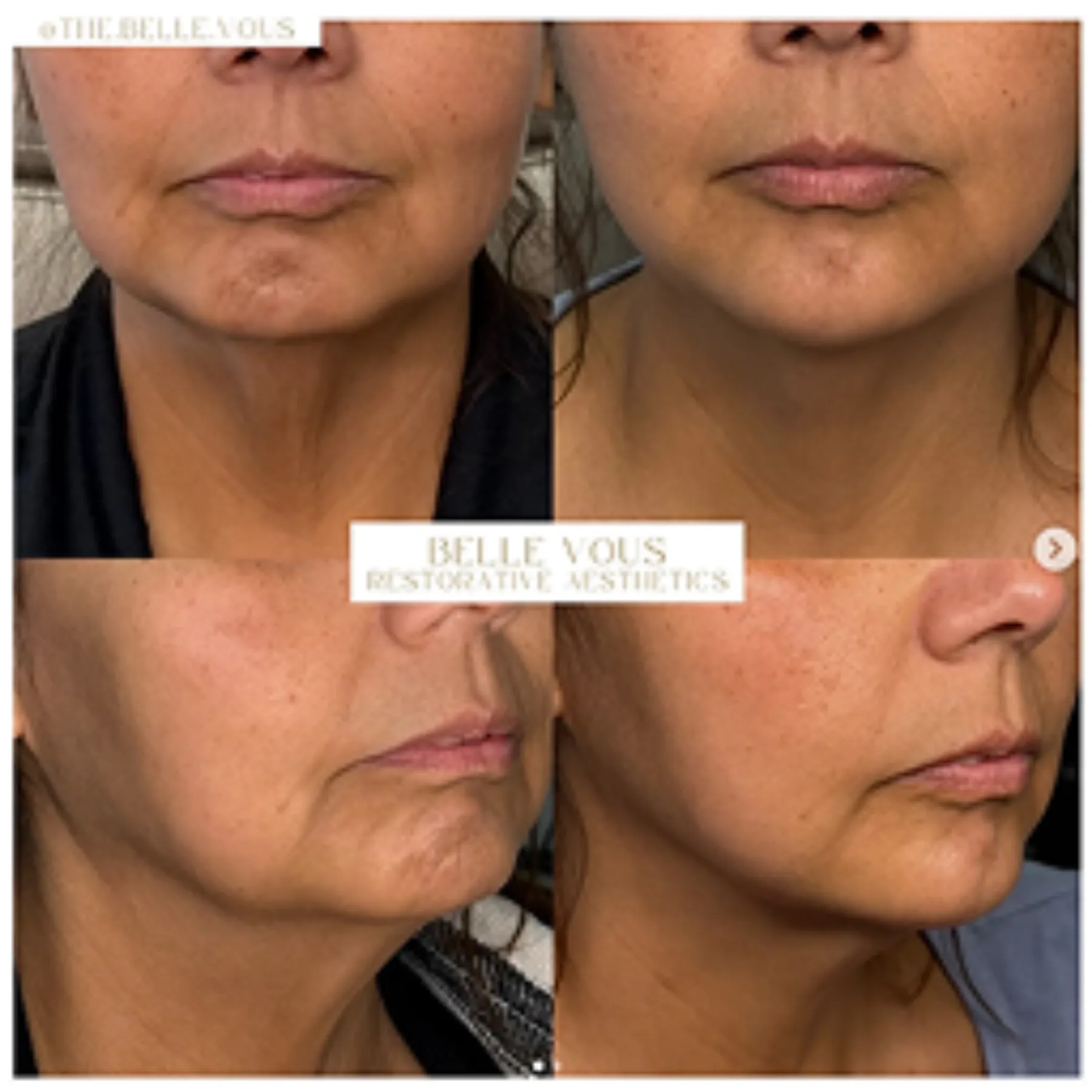 wrinkles solution in Williamsville, NY