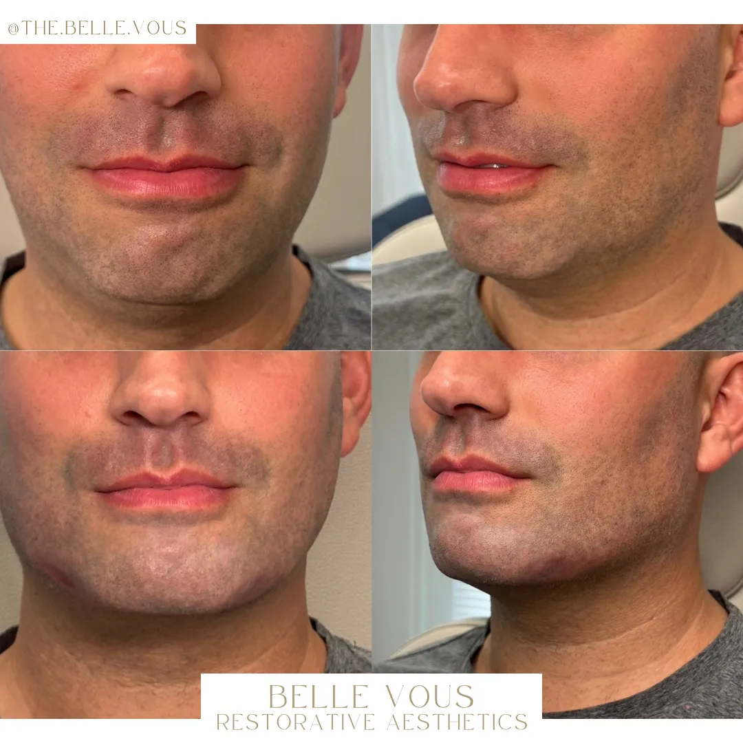 Chin filler four before and after gallery in Williamsville NY