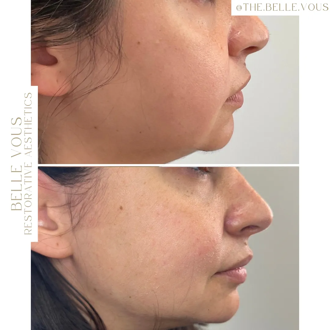 Chin filler one before and after gallery in Williamsville NY