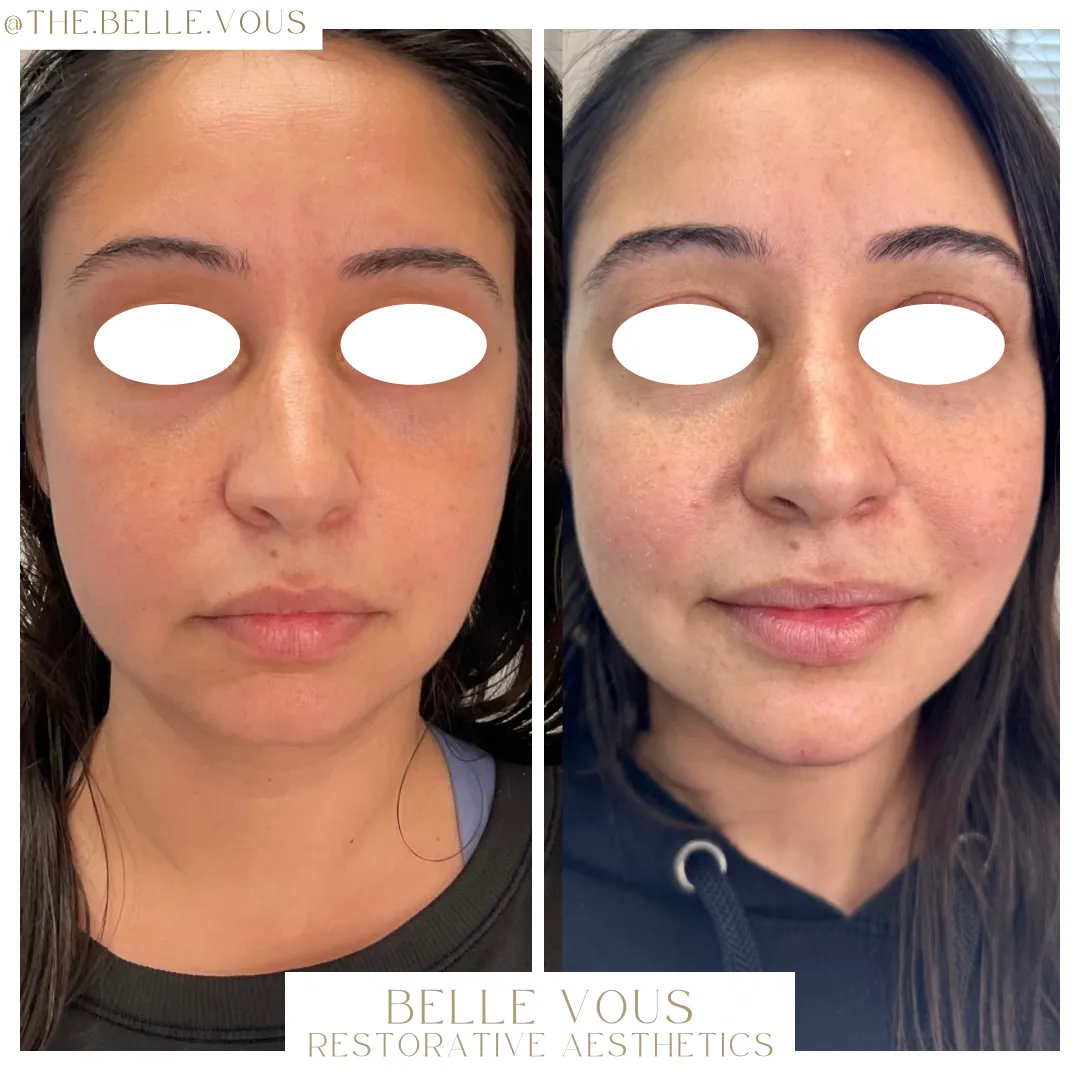 Chin filler three before and after gallery in Williamsville NY