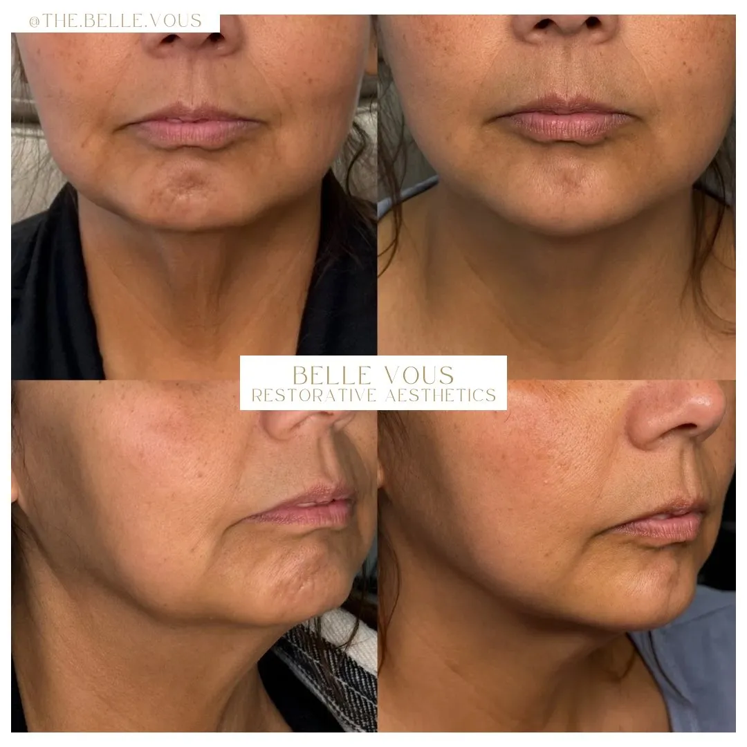 Chin filler two before and after gallery in Williamsville NY