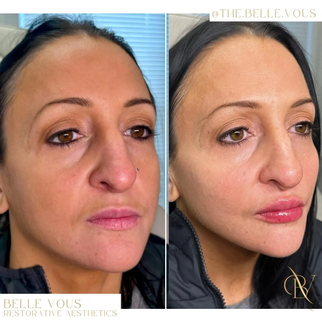 Facial balancing before and after gallery in Williamsville NY