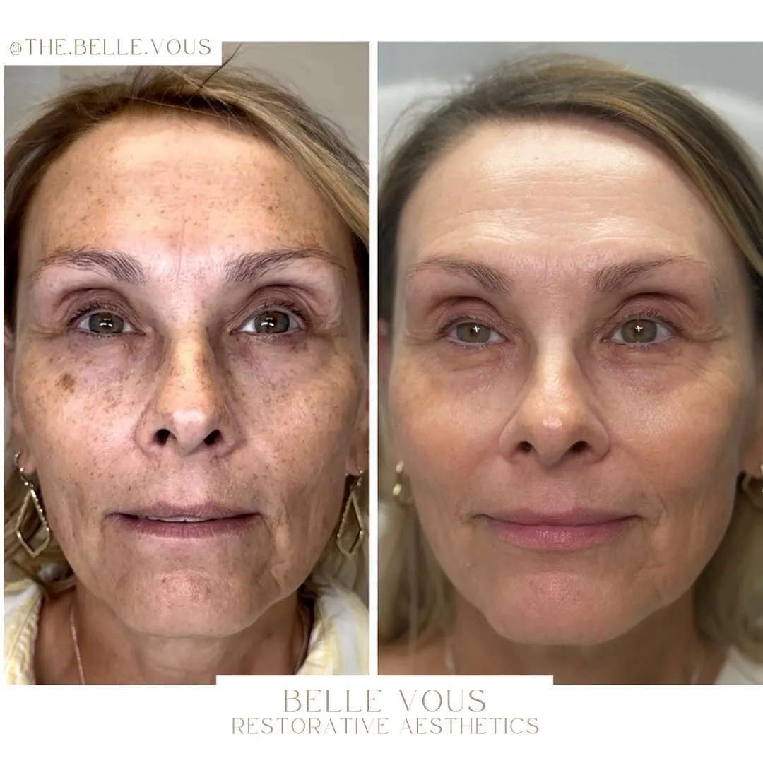 IPL one before and after gallery in Williamsville NY