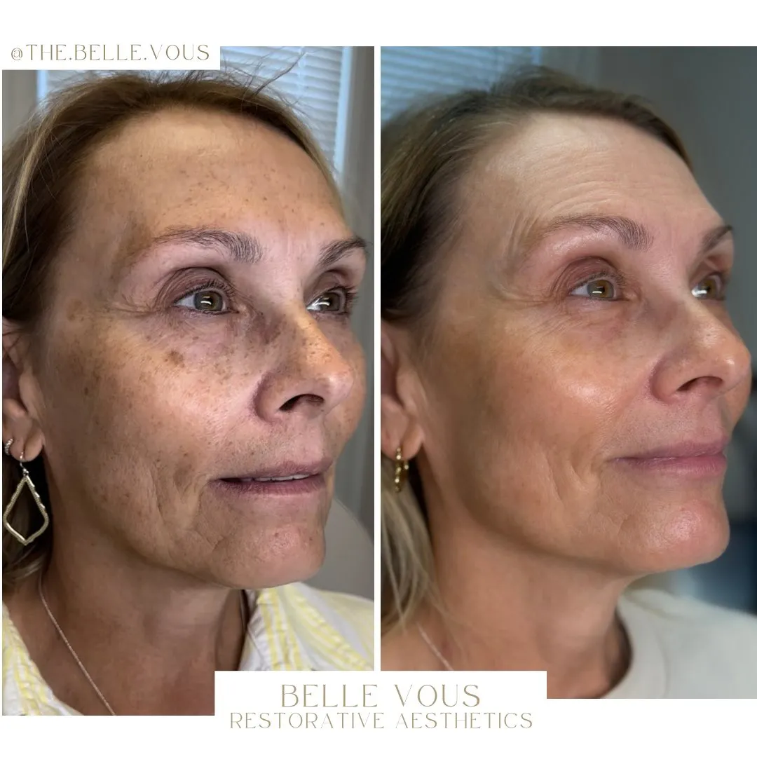 Skinpen Microneedling one before and after gallery in Williamsville NY