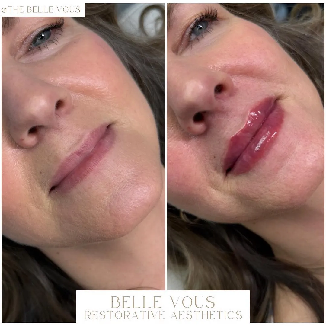 Lip Filler eight before and after gallery in Williamsville NY