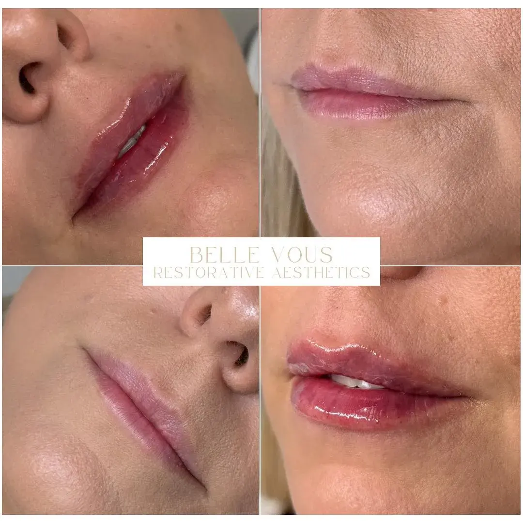 Lip Filler eleven before and after gallery in Williamsville NY 11