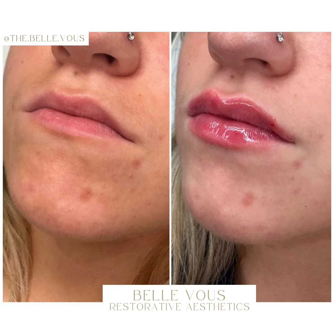 Lip Filler fifteen before and after gallery in Williamsville NY