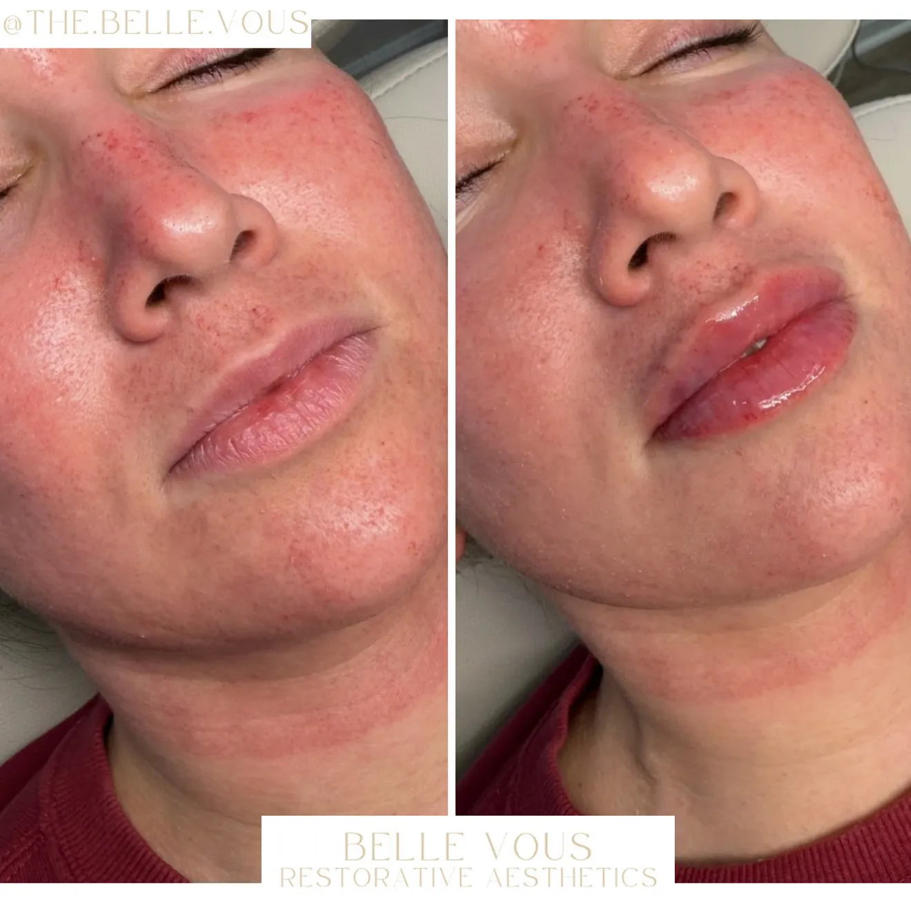 Lip Filler five before and after gallery in Williamsville NY