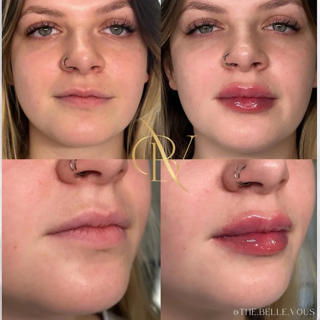 Lip Filler four before and after gallery in Williamsville NY