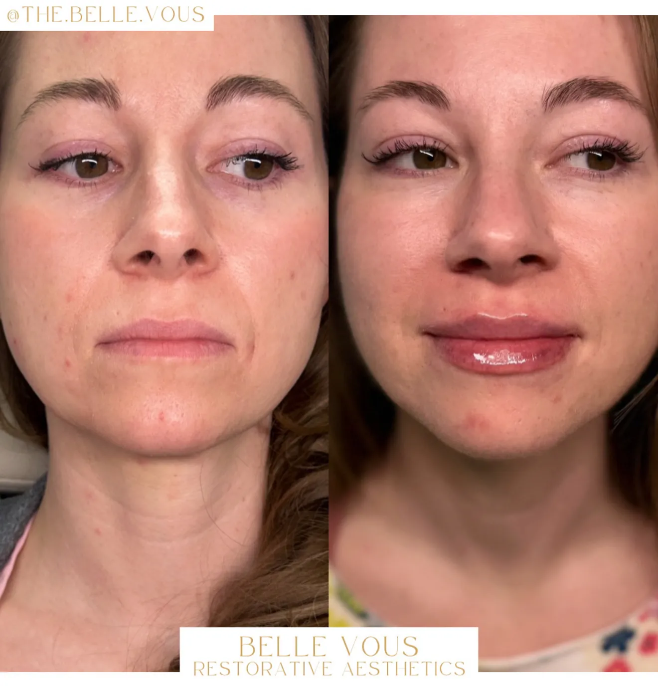 Lip Filler fourteen before and after gallery in Williamsville NY