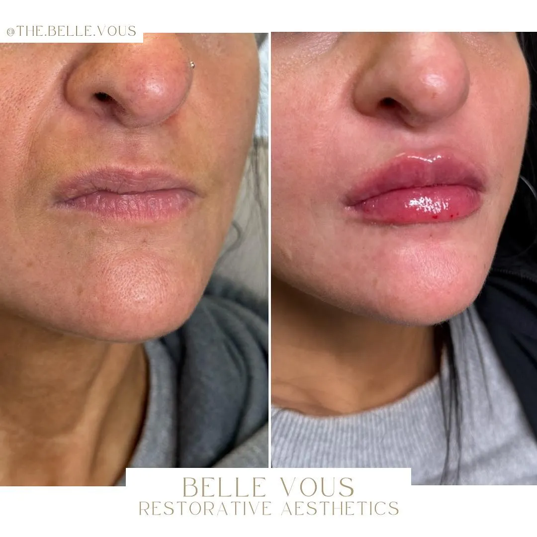 Lip Filler nine before and after gallery in Williamsville NY
