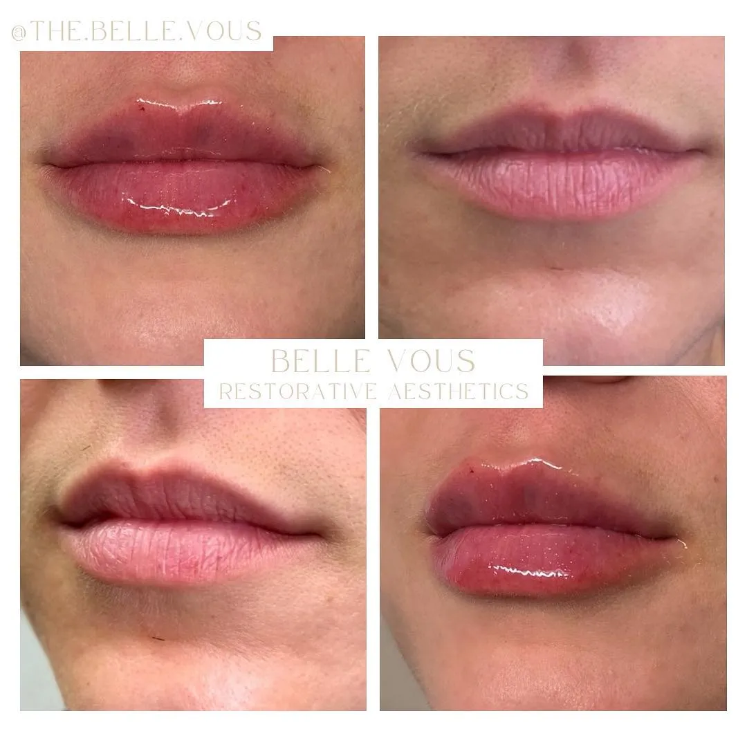 Lip Filler one before and after gallery in Williamsville NY