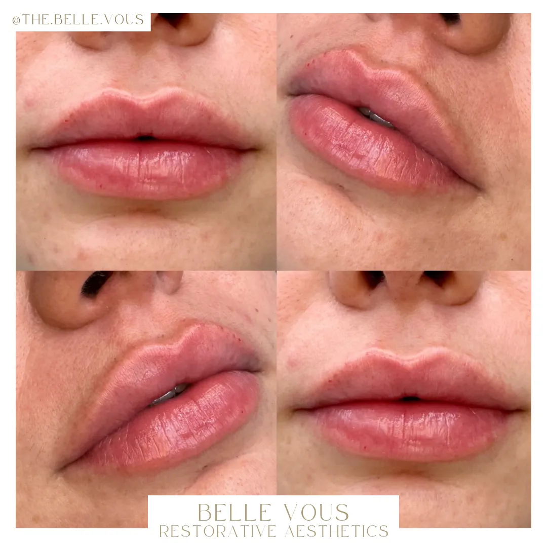Lip Filler seven before and after gallery in Williamsville NY