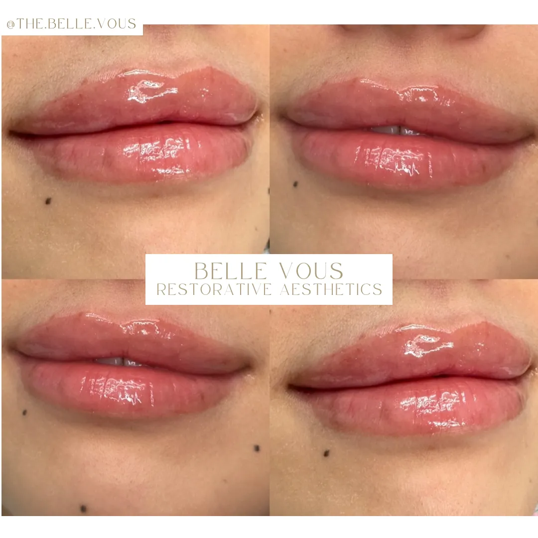 Lip Filler six before and after gallery in Williamsville NY