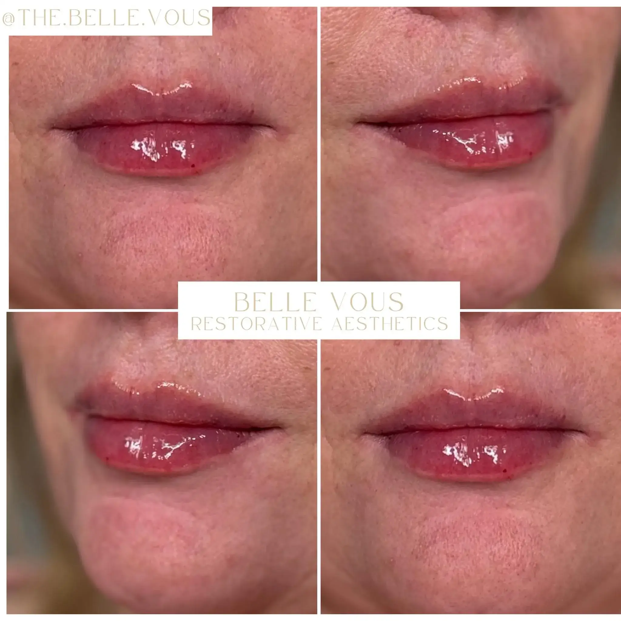 Lip Filler ten before and after gallery in Williamsville NY 11