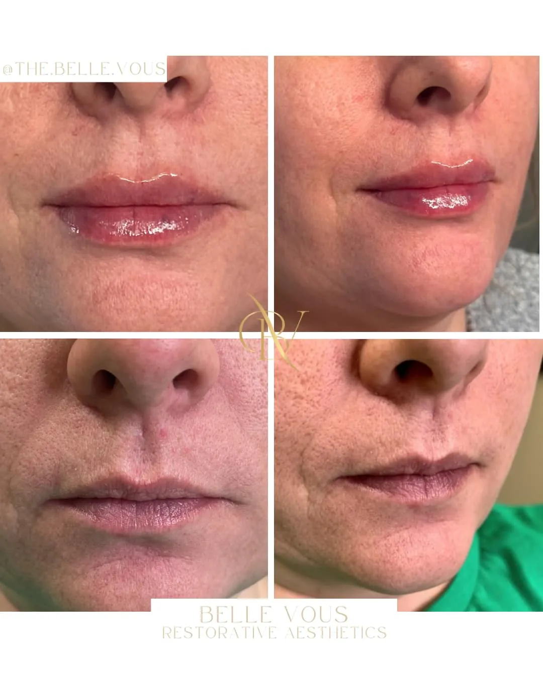 Lip Filler thirteen before and after gallery in Williamsville NY