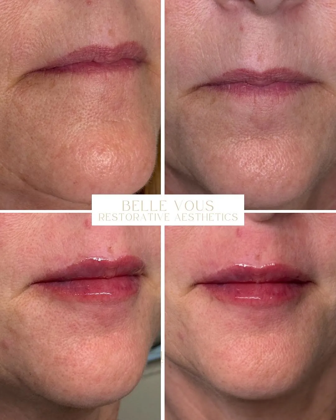 Lip Filler three before and after gallery in Williamsville NY
