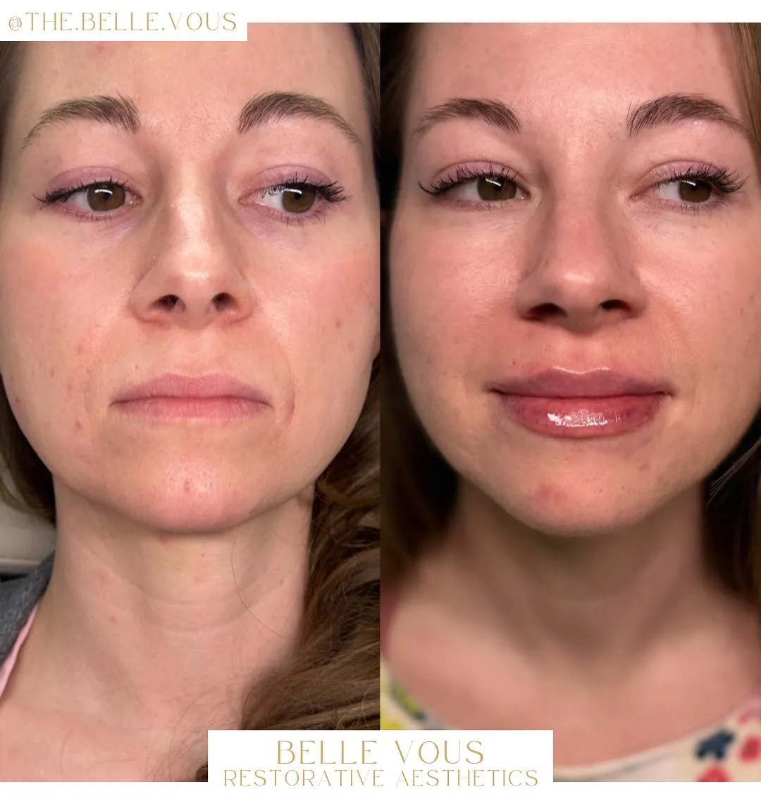 Lip Filler twelve before and after gallery in Williamsville NY