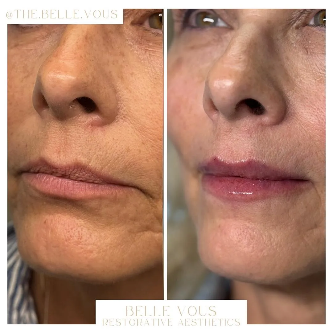 Lip Filler two before and after gallery in Williamsville NY