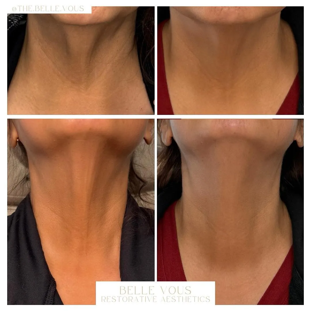 Radiesse neck three before and after gallery in Williamsville NY