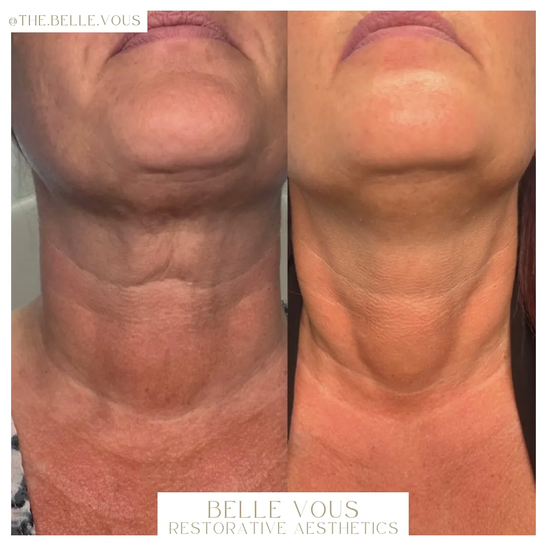 Radiesse neck one before and after gallery in Williamsville NY