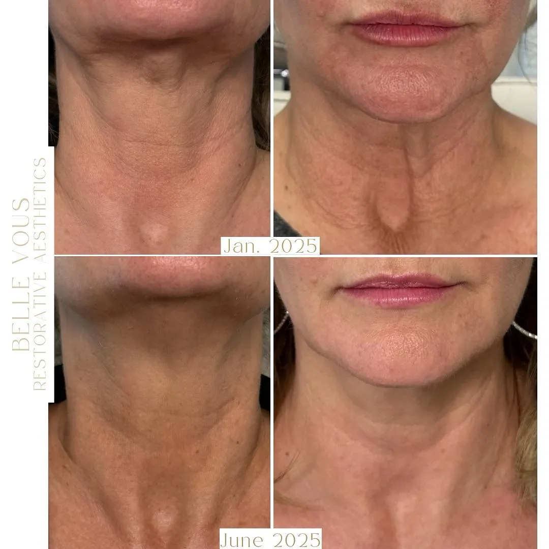Radiesse neck three before and after gallery in Williamsville NY
