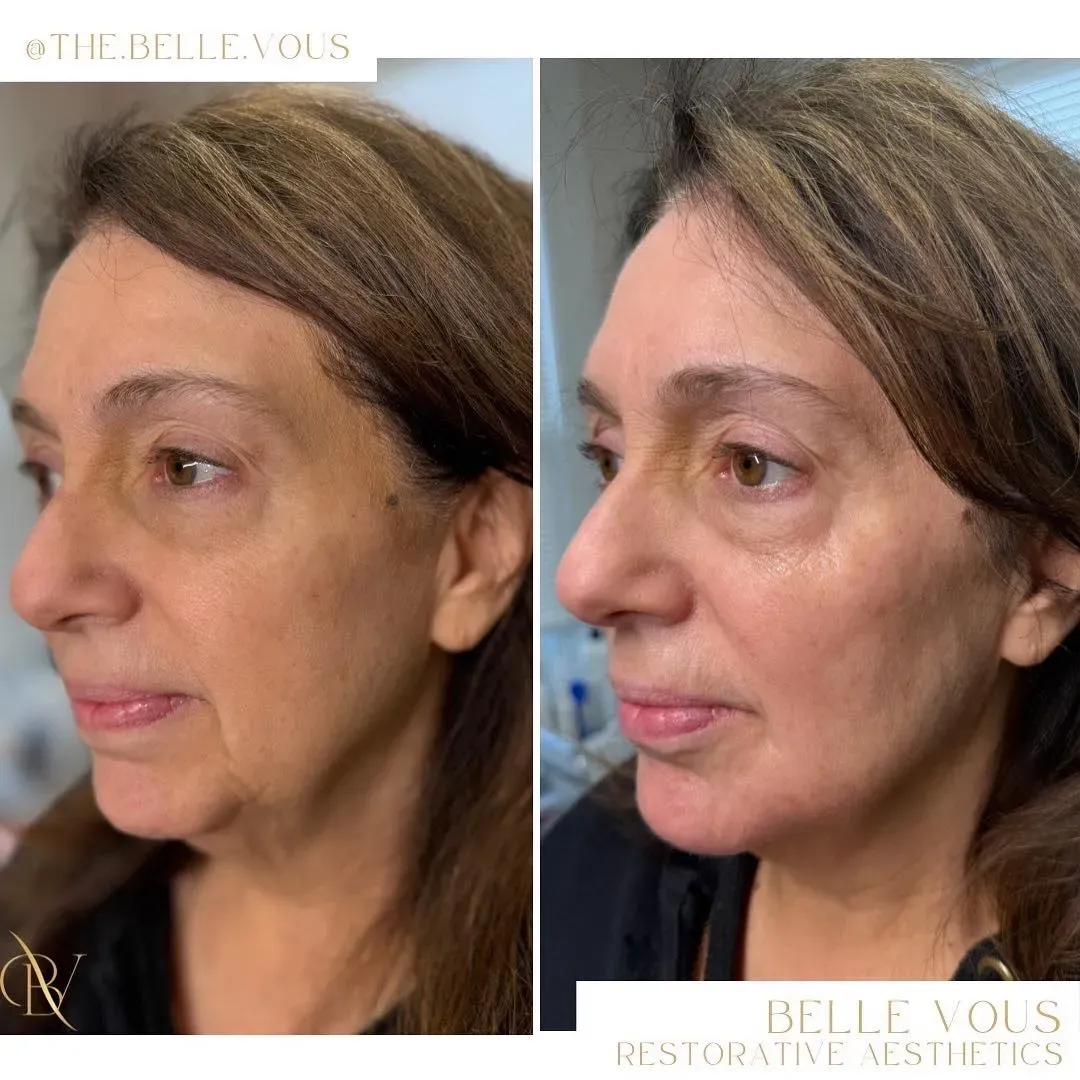 Radiesse Full Face before and after gallery in Williamsville NY