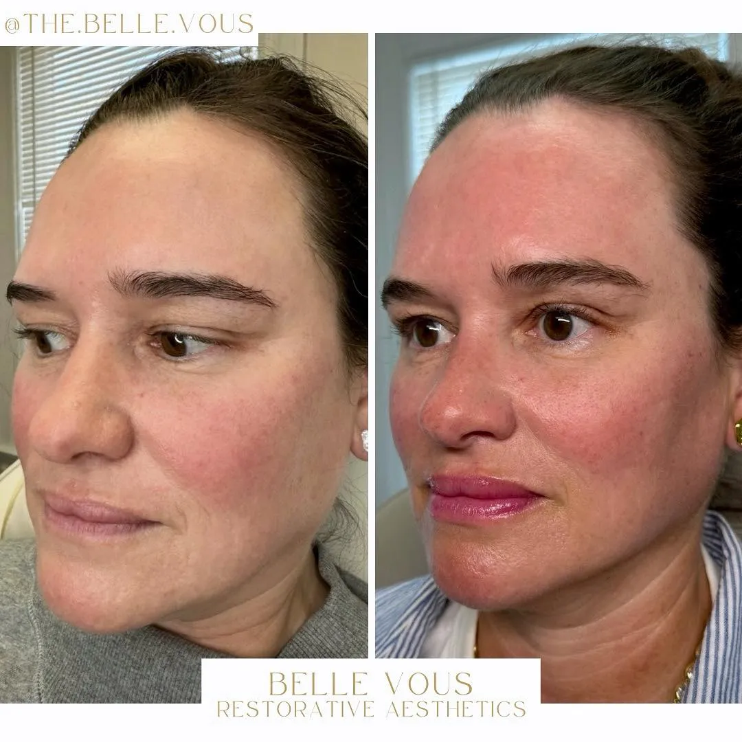 Radiesse Full Face one before and after gallery in Williamsville NY