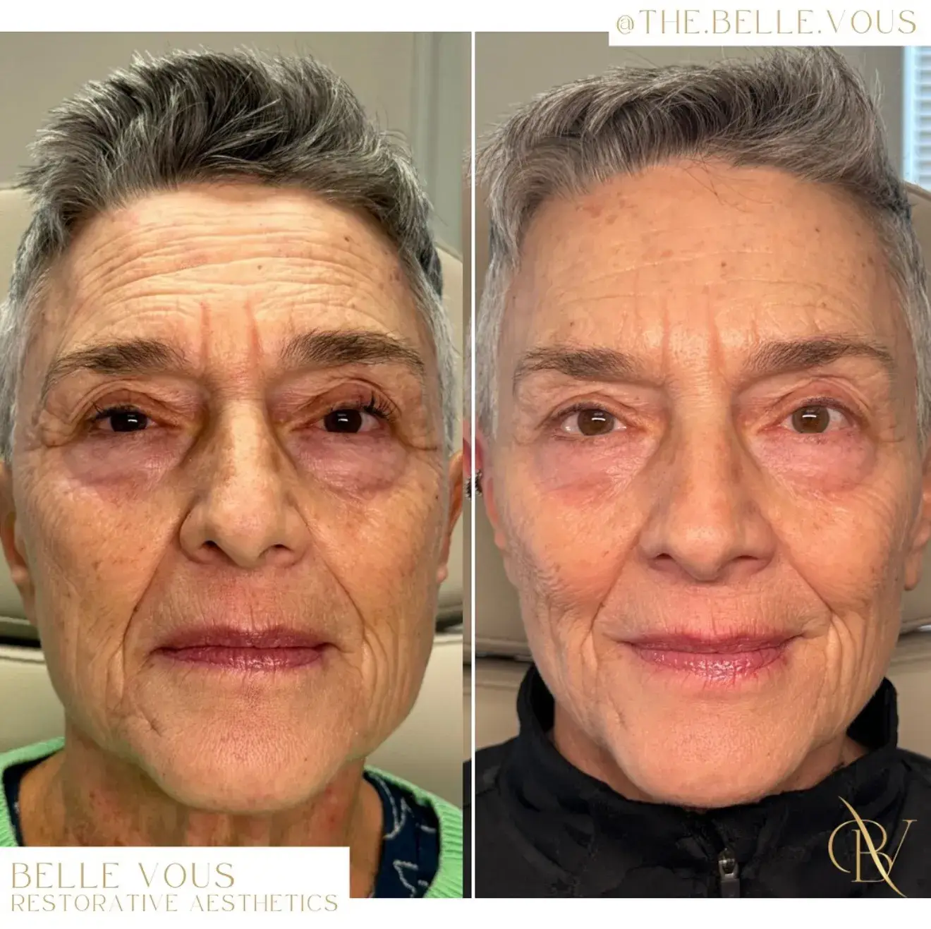 SKINBETTER TOX before and after gallery in Williamsville NY
