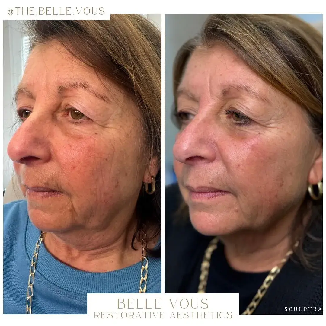 Sculptra one before and after gallery in Williamsville NY