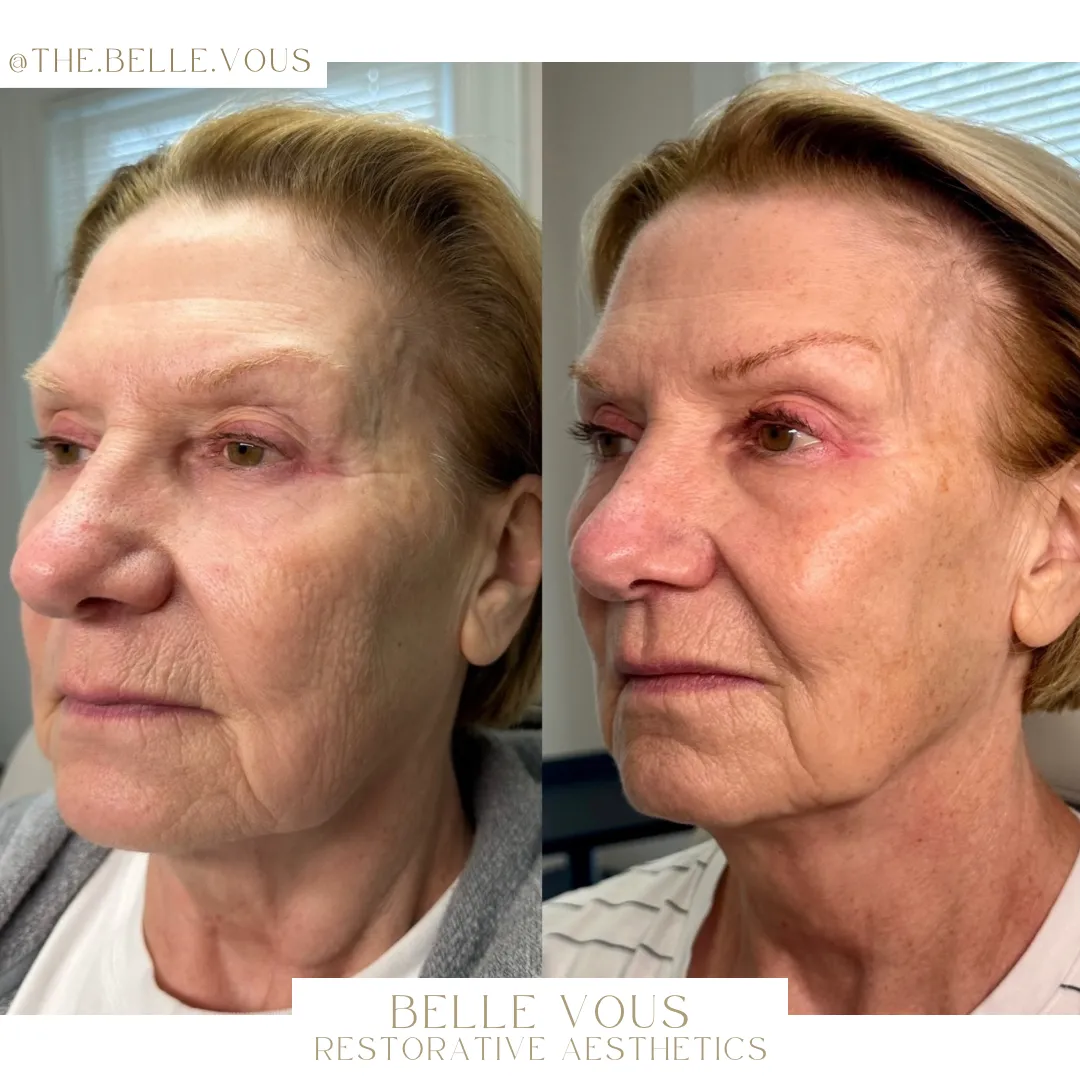 Sculptra three before and after gallery in Williamsville NY