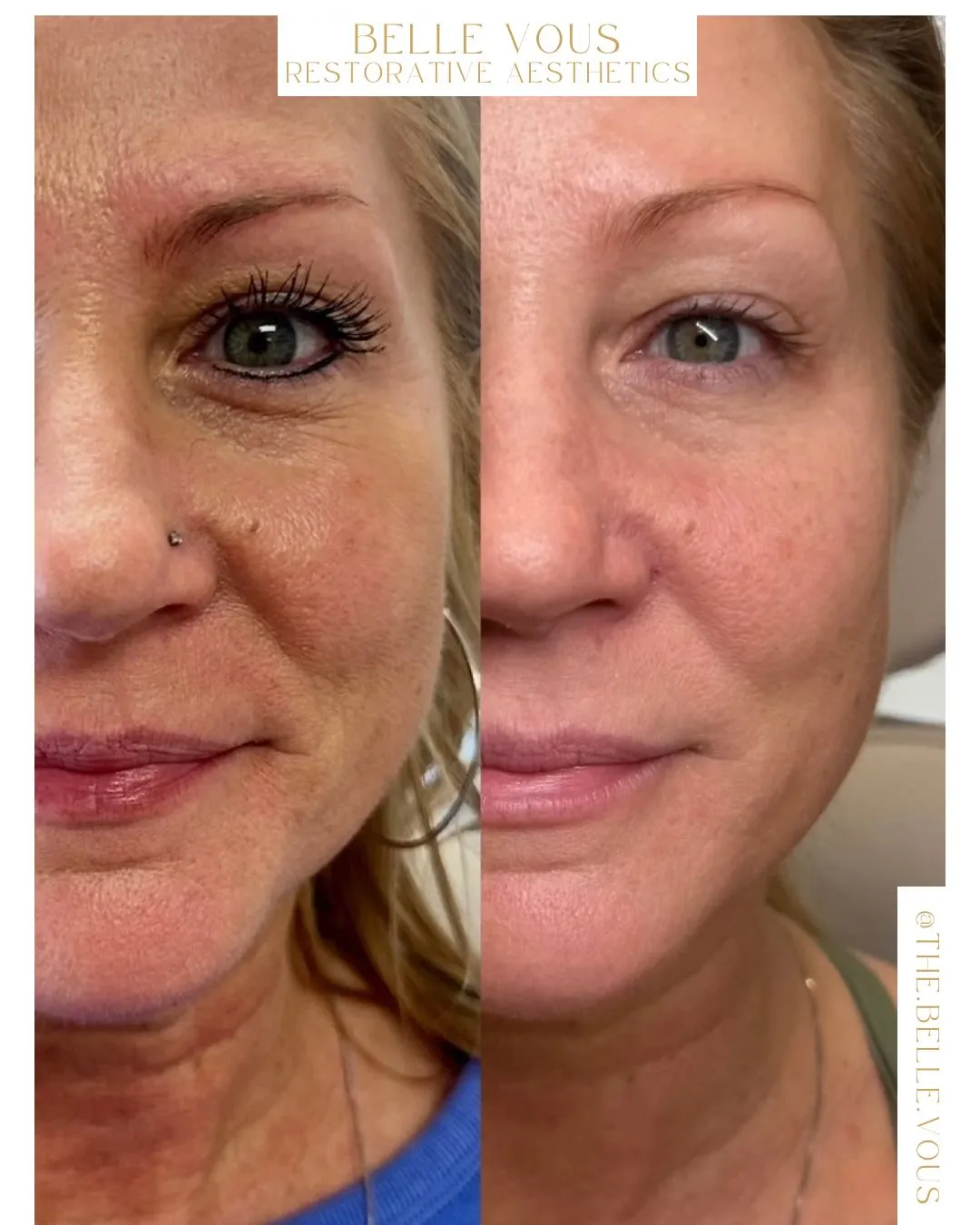 Sculptra two before and after gallery in Williamsville NY