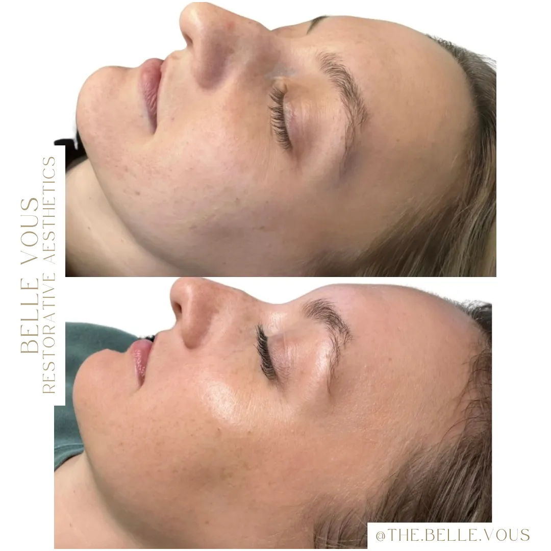 Skinpen Microneedling four before and after gallery in Williamsville NY