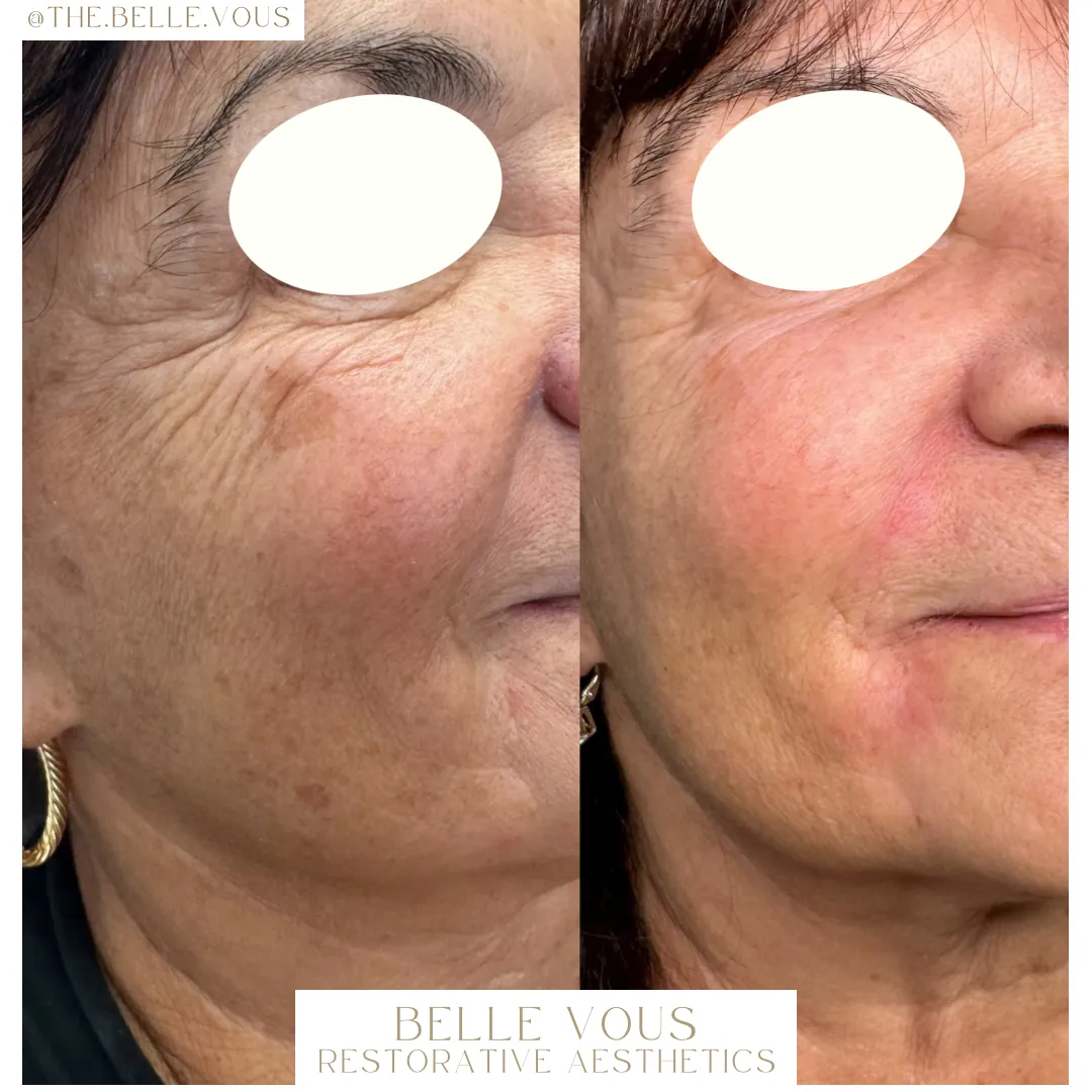 Skinpen Microneedling one before and after gallery in Williamsville NY