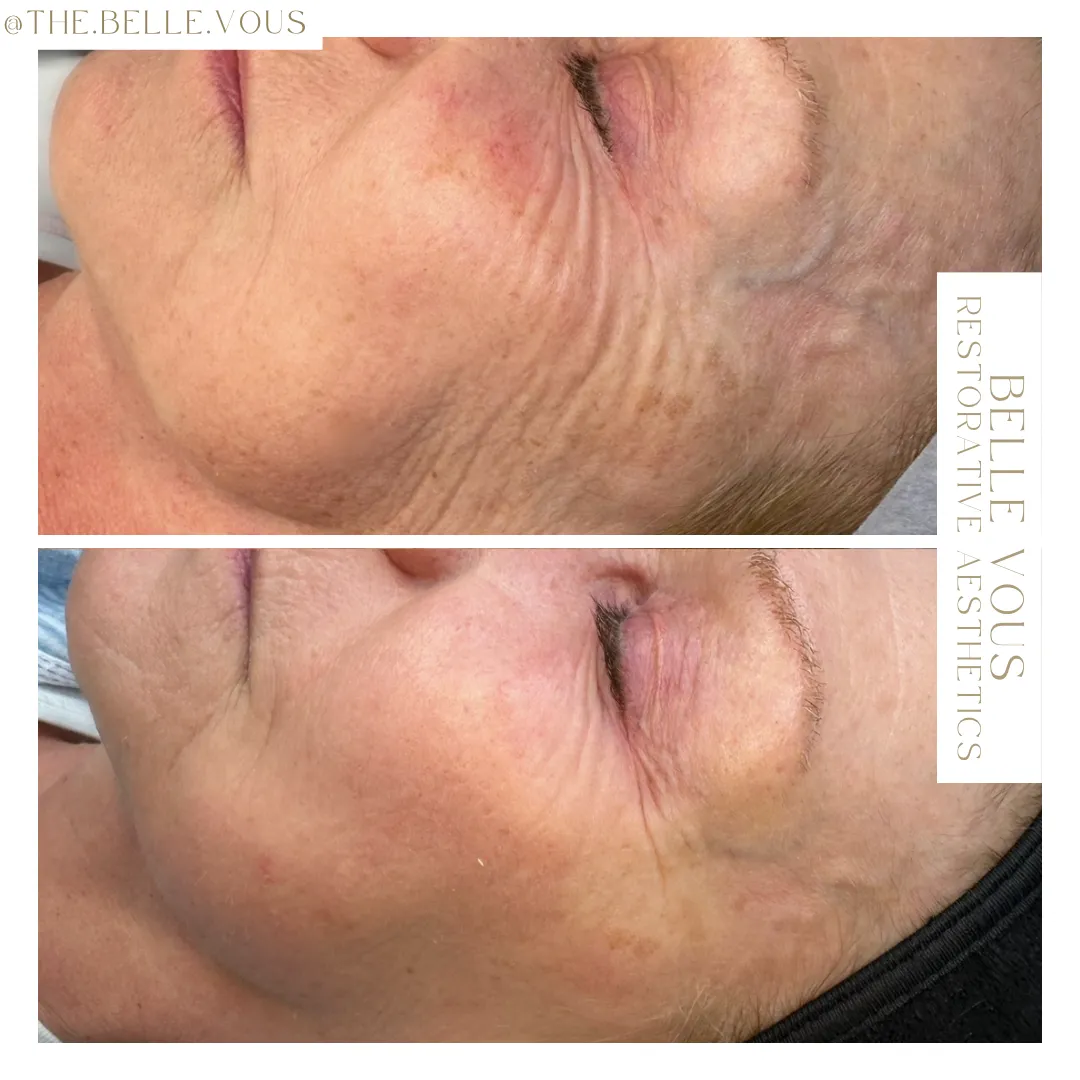Skinpen Microneedling three before and after gallery in Williamsville NY