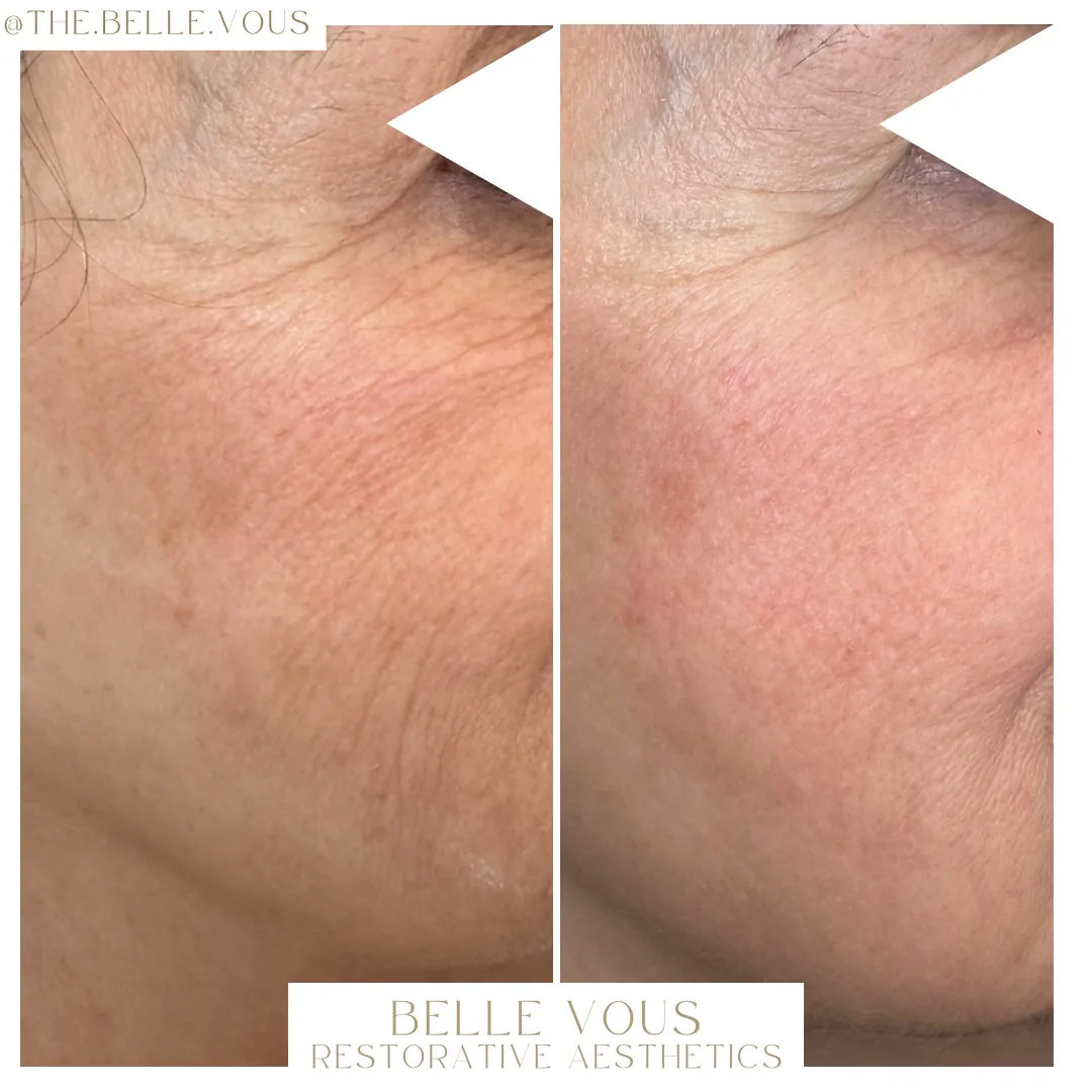 Skinpen Microneedling two before and after gallery in Williamsville NY